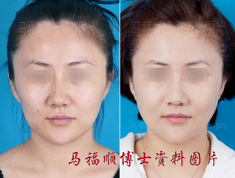 getting younger after facial bone reduction surgery