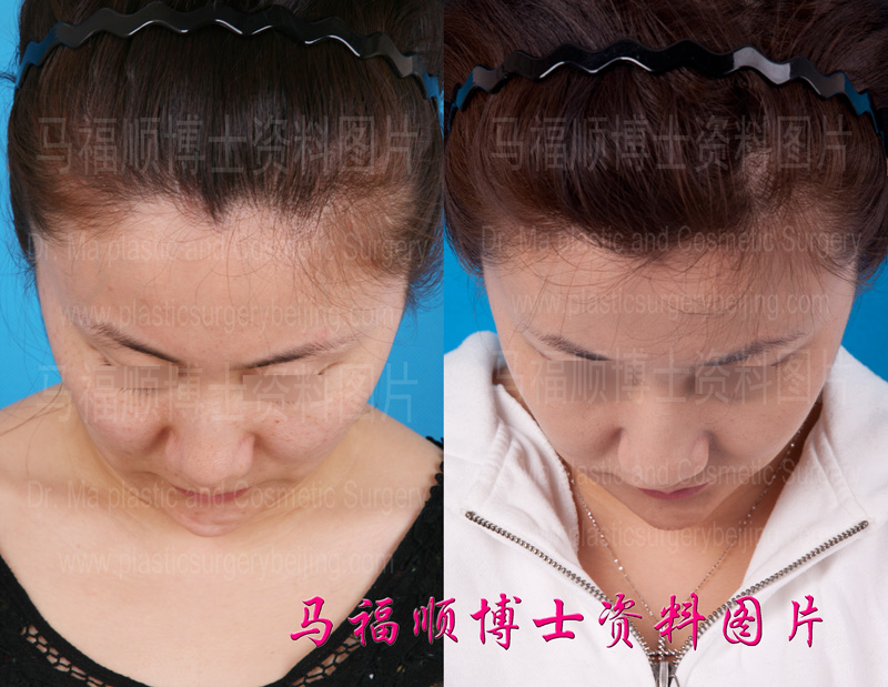 facial skin tight effect of zygomatic bone and mandibular bone reduction surgery