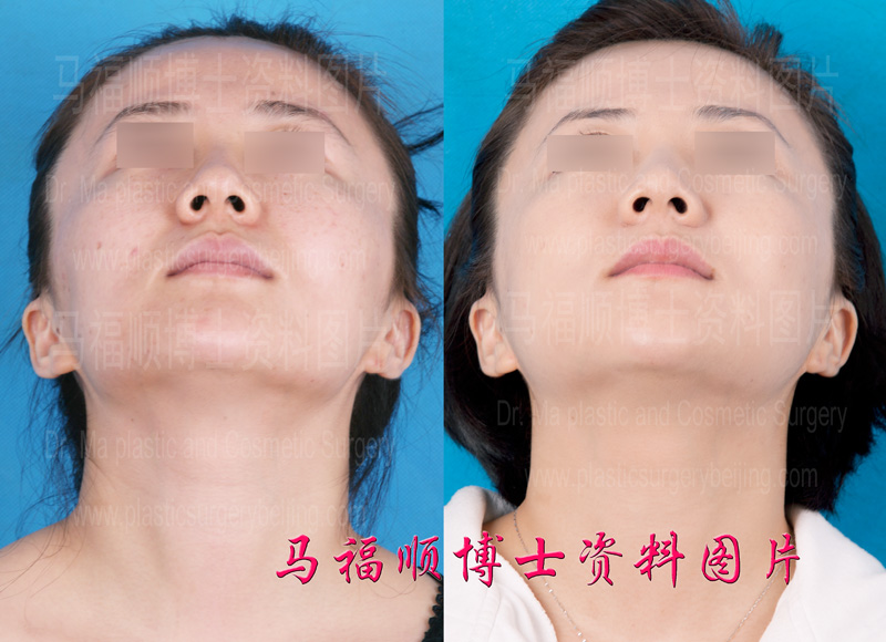chin up position after zygomatic and mandibular bone reduction surgeries