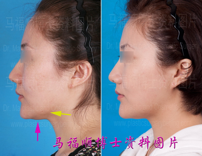 lift of facial skin after facial bone reduction surgery