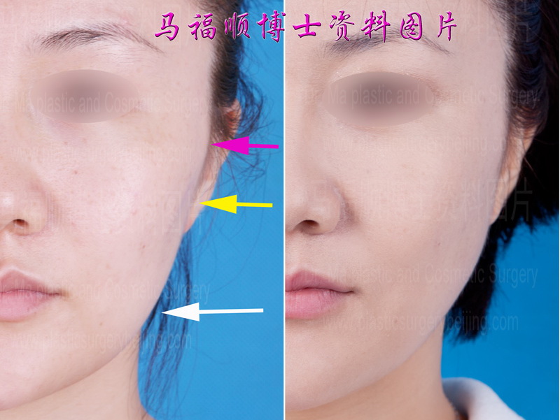 facial outlin changes after zygomatic bone and mandibular bone reduction surgery