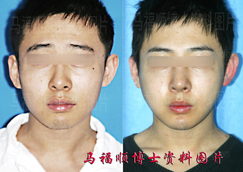 zygomatic bone and zygomatic arch reddution surgery