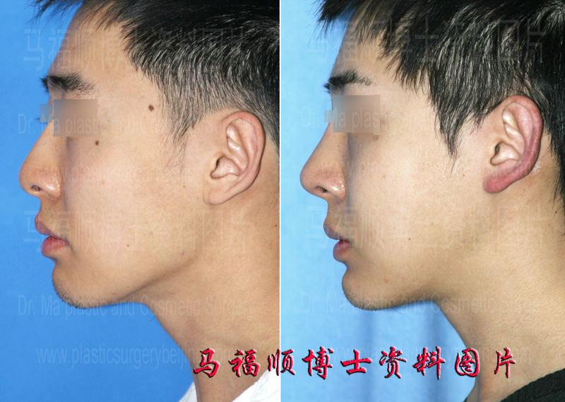 mandible reduction and chin augmentation with self bone