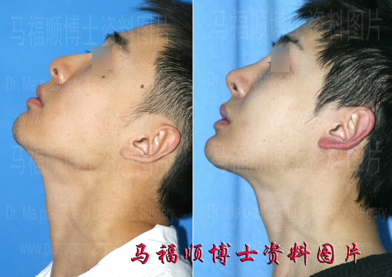 mandible angle and masseter muscle reduction