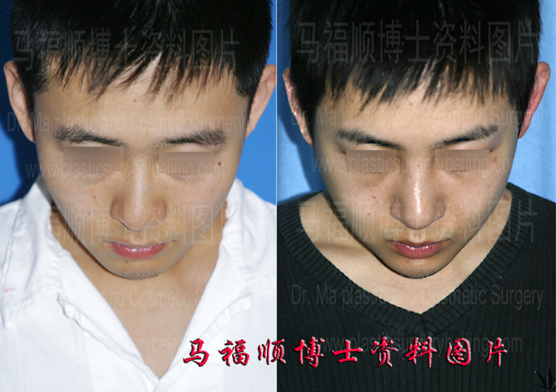 zygomatic bone and zygomatic arch reduction surgery