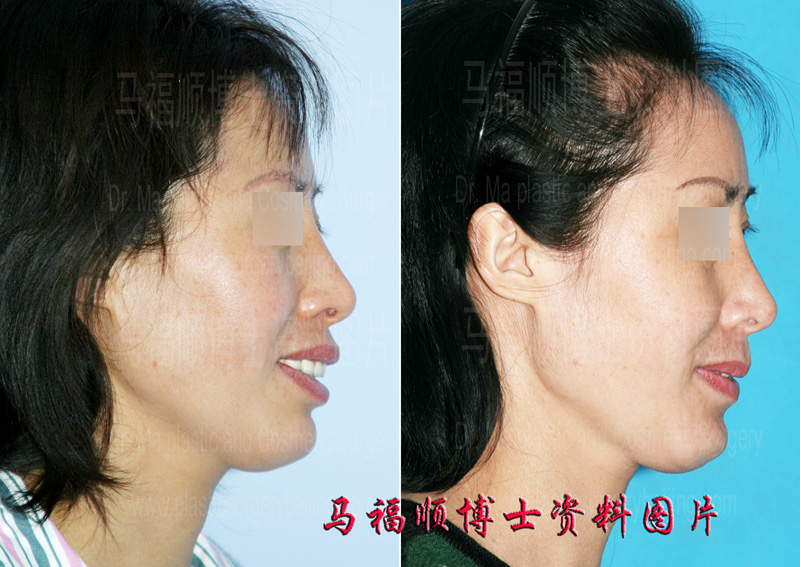 bimaxillary protrusion plastic surgery
