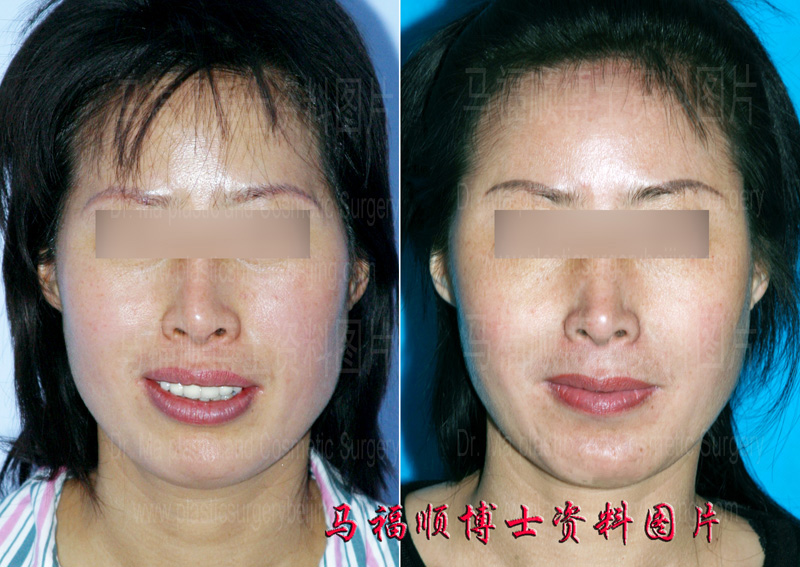 parted lips and sticking teeth