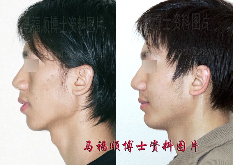mouth protrusion plastic surgery mouth protrusion plastic surgery