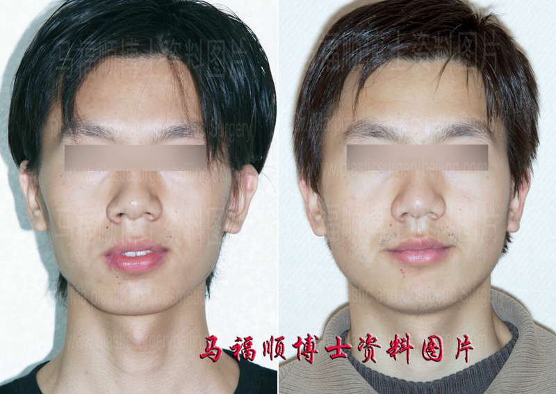 protruded mouth plastic surgery protruded mouth plastic surgery