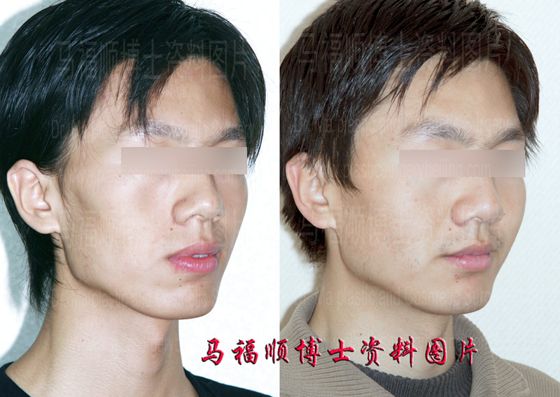 protrusion mouth plastic surgery protrusion mouth plastic surgery