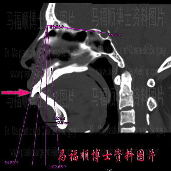 bimaxillary protrusion CT bimaxillary protrusion CT