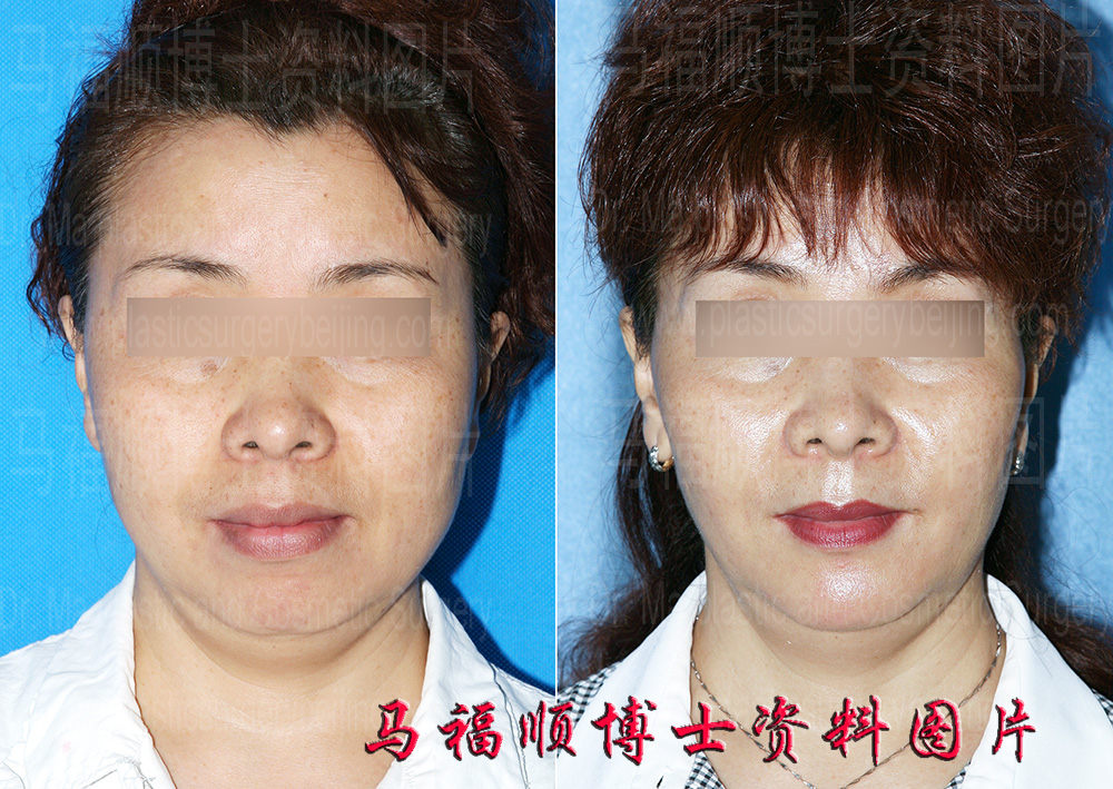 bimaxillary plastic surgery frontal view