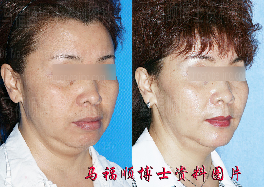 bimaxillary plastic surgery in profile