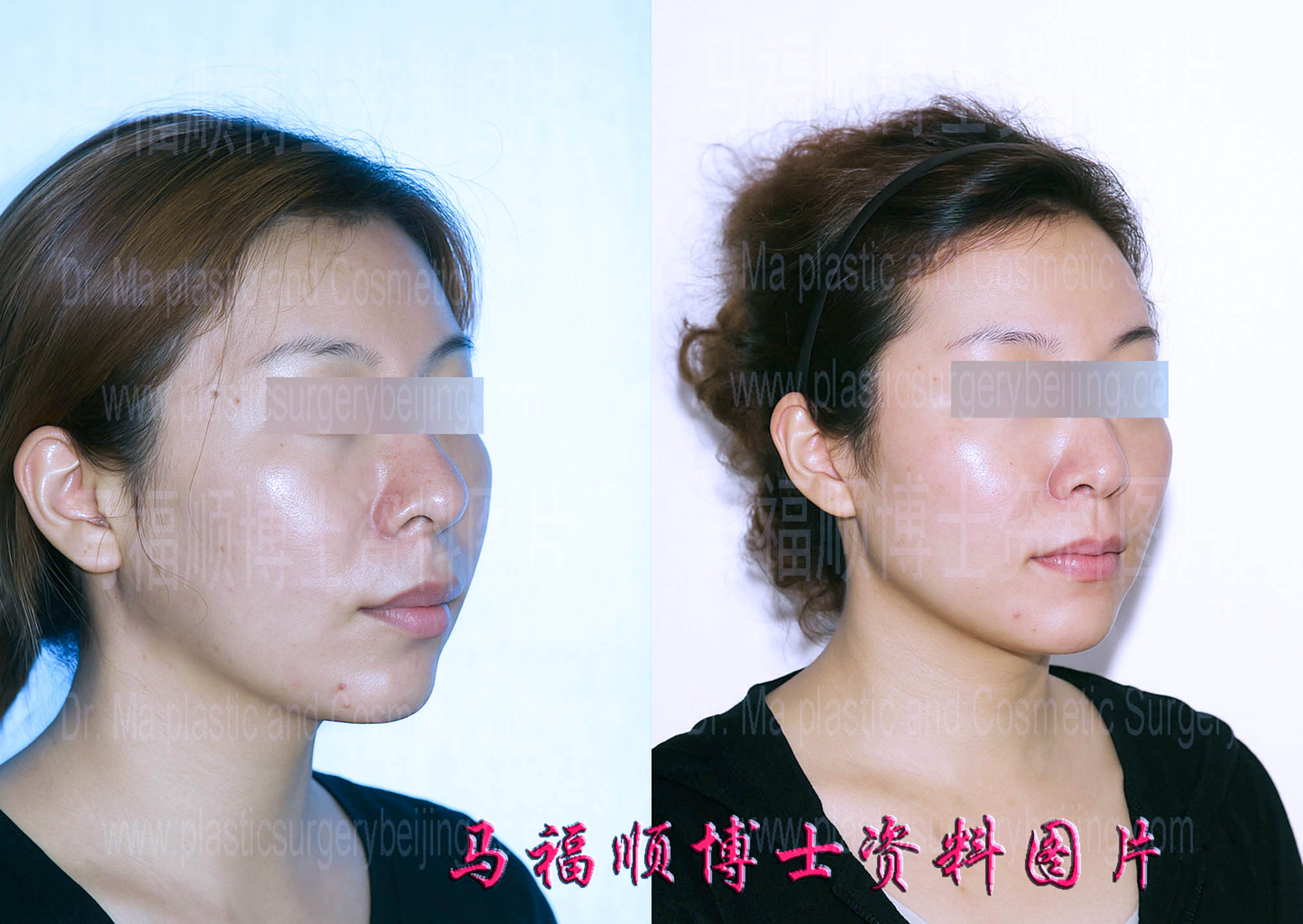 Bimaxillary setback surgery 45-degree view showing improved upper lip projection