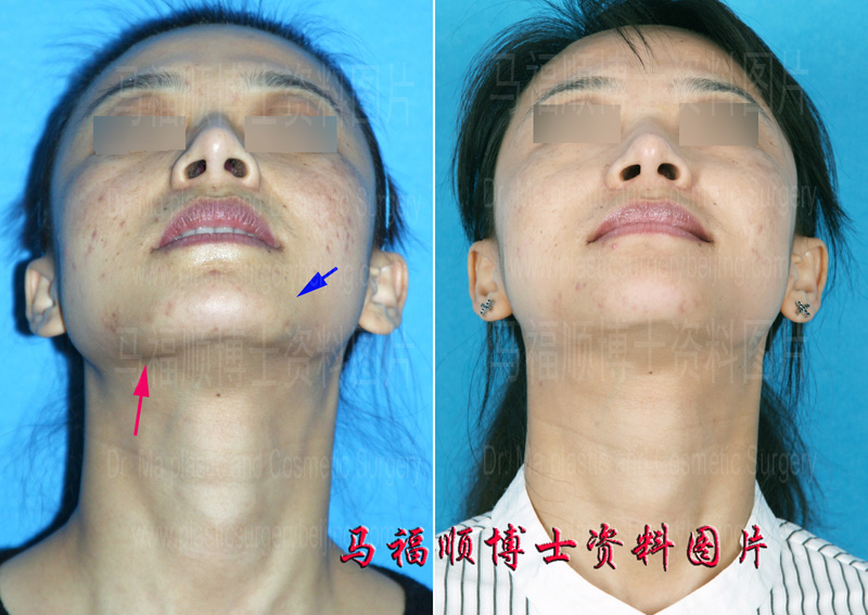 revision surgery after mandible angle reduction