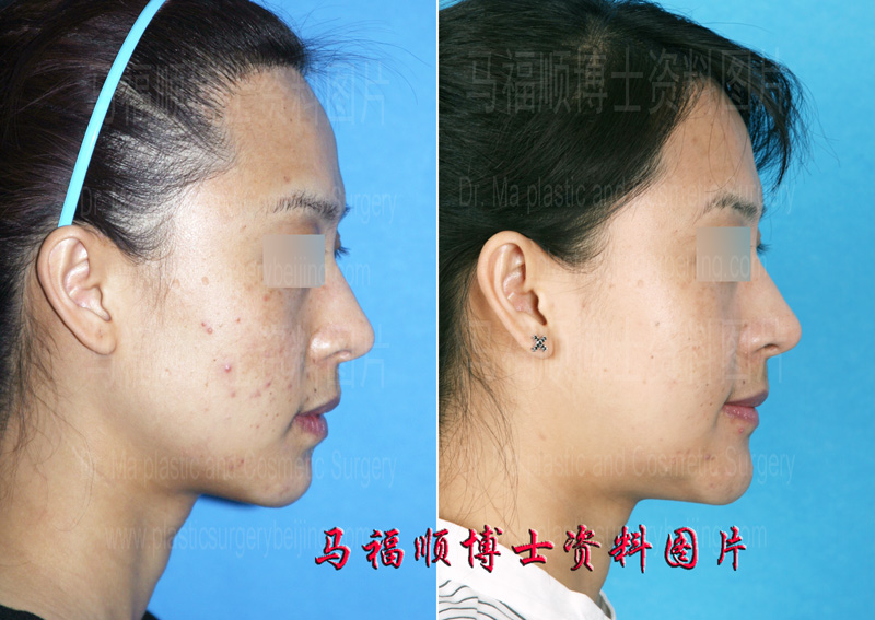 plastic surgery of the mandible bone