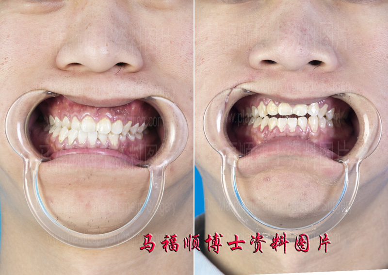 teeth in deviated face