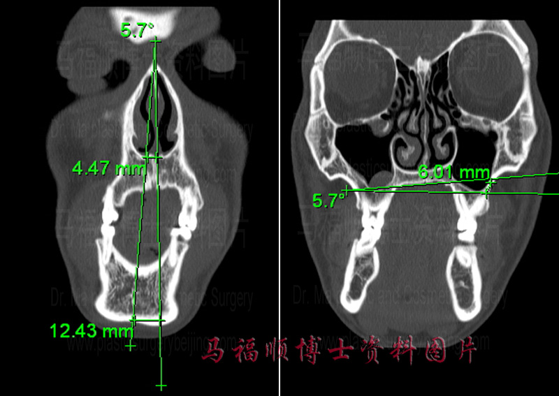 CT image of deviated face