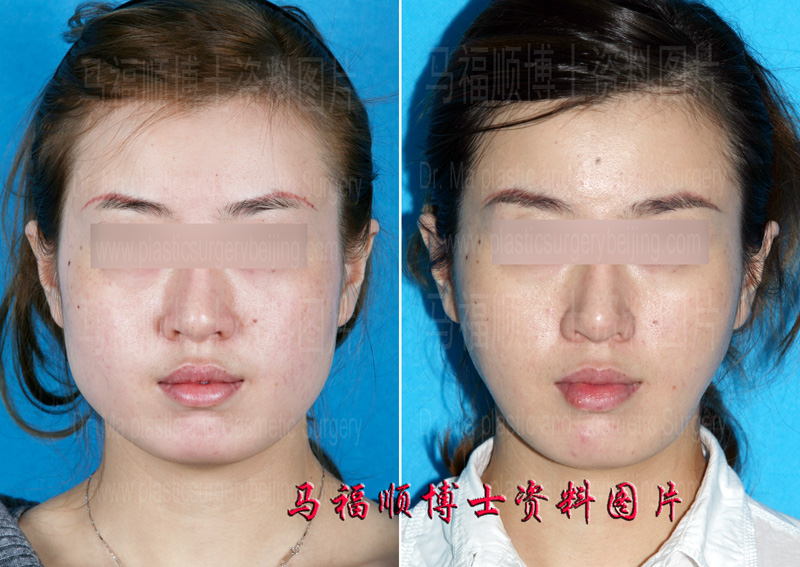 mandible and masseter muscle reduction