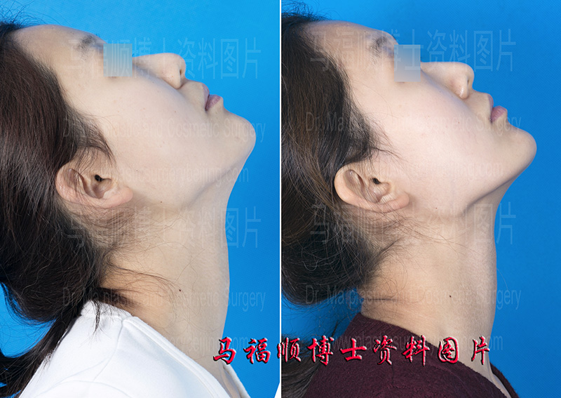 the angle of mandible is reserved after mandible reduction surgery