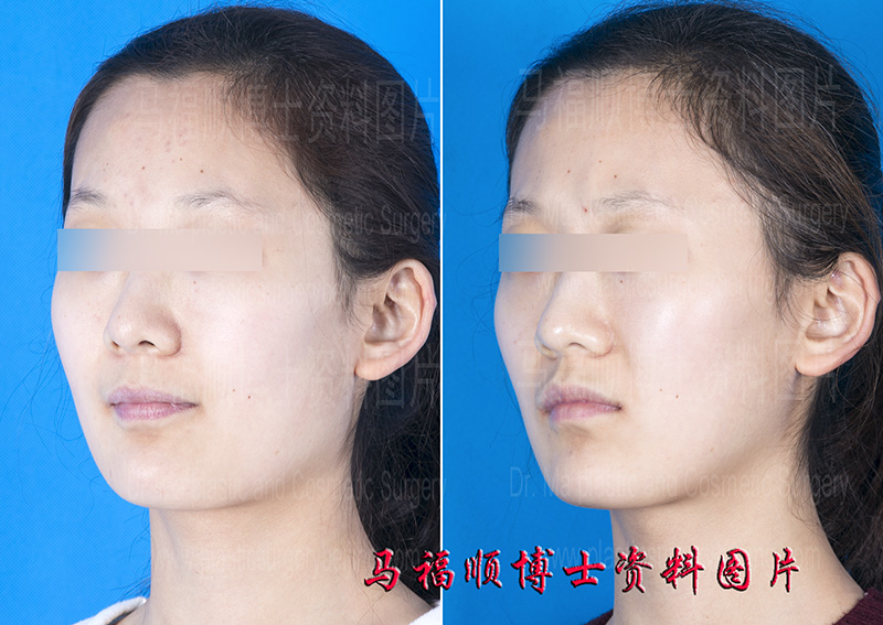 angle reserve mandible reduction