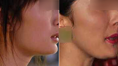 horse face deformity