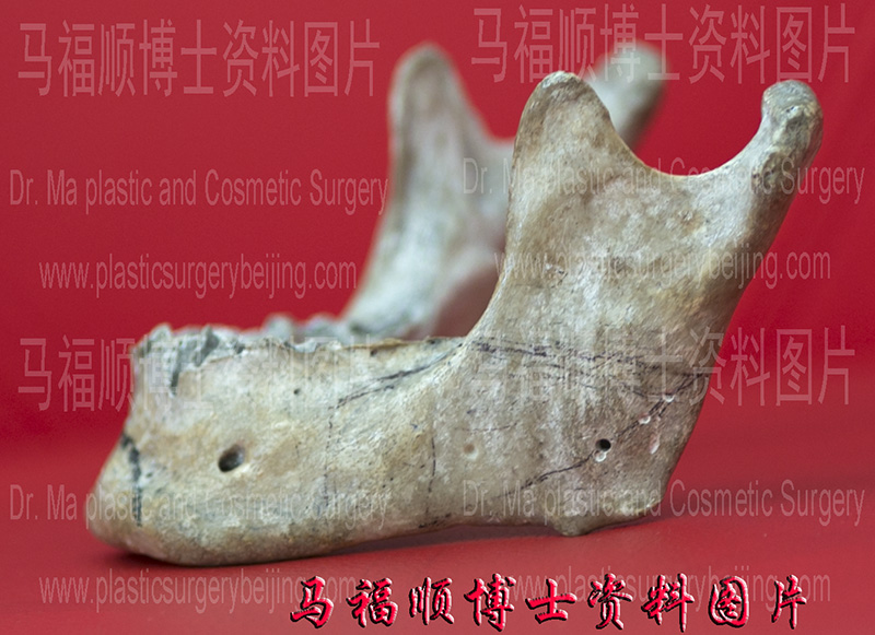 angle of mandible