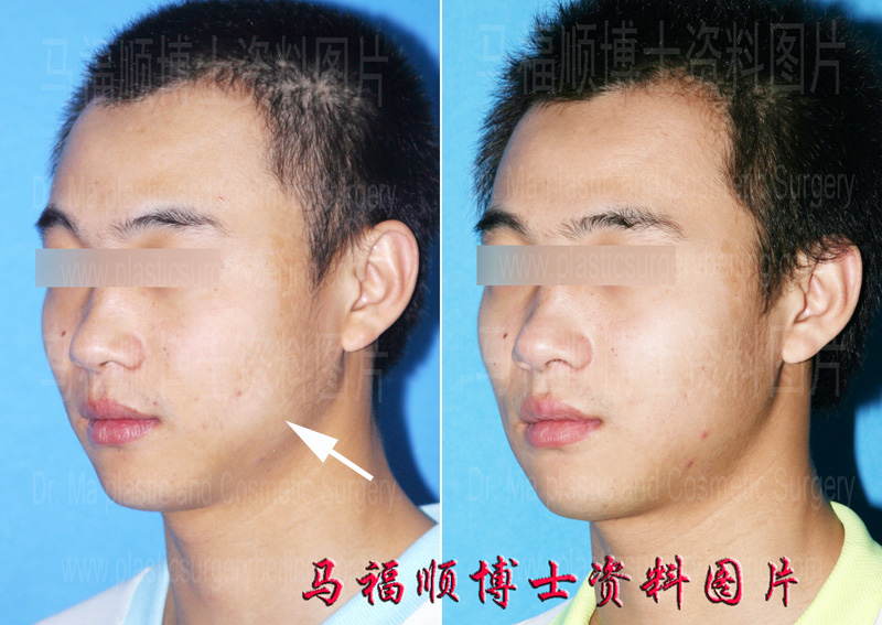 masseter muscle partial resection masseter muscle partial resection