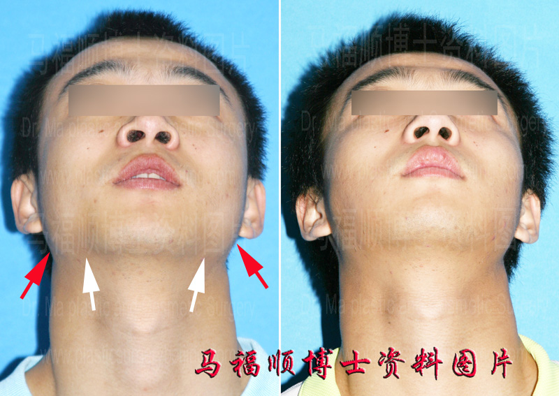 chin up position after masseter muscle and buccal fat removal