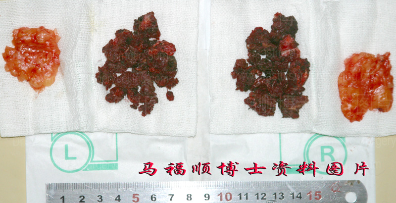 the removed muscle and fat tissue the removed muscle and fat tissue