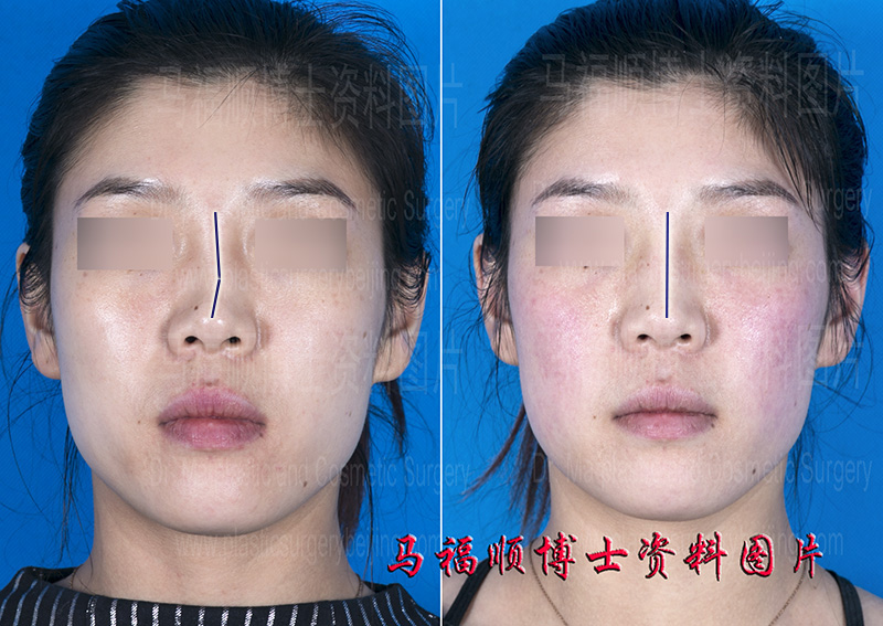 early correction for nasal bone fracture