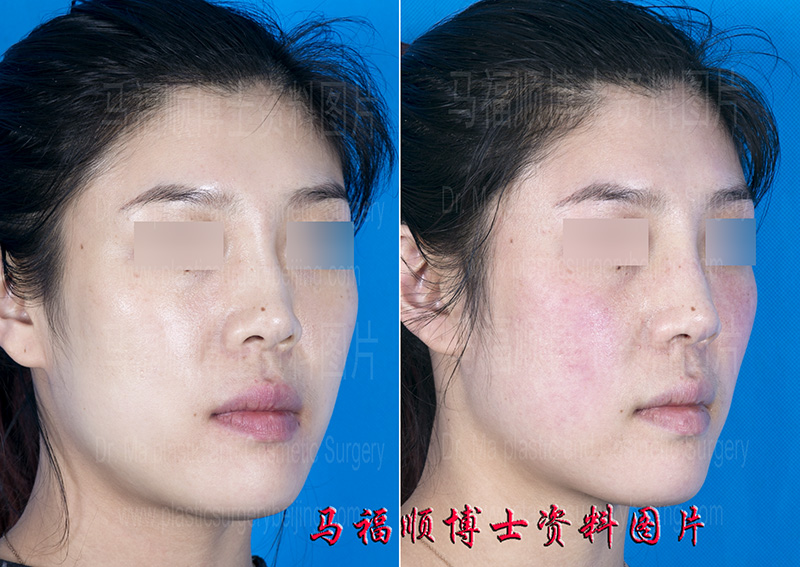 deformity correction after nasal injury