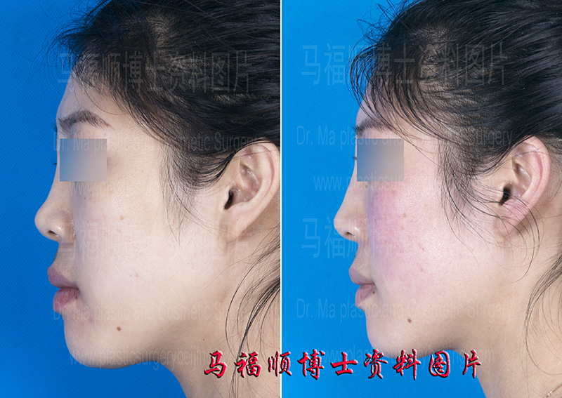 plastic surgery after nasal bone injury