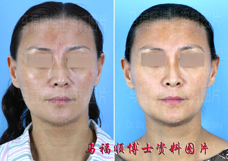 twisted hump nose plastic surgery twisted hump nose plastic surgery