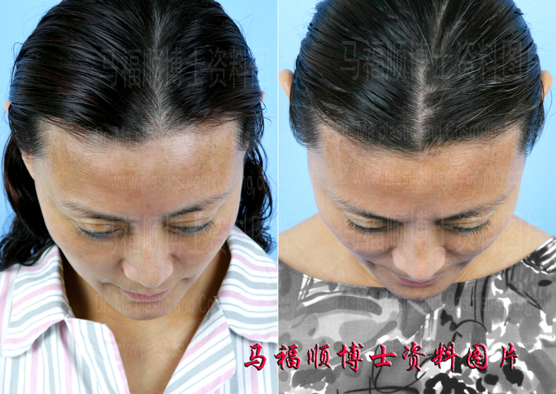 nasal dorsum left deviation correction nasal dorsum left deviation correction