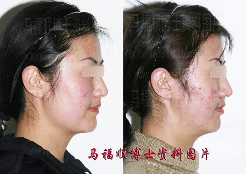 zygomatic reduction for a slimmer face