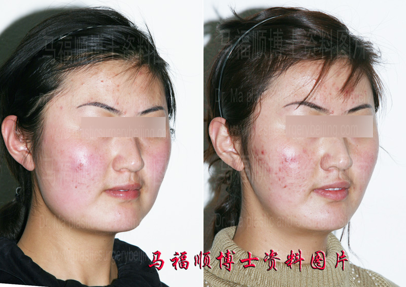 facial slimmer surgery
