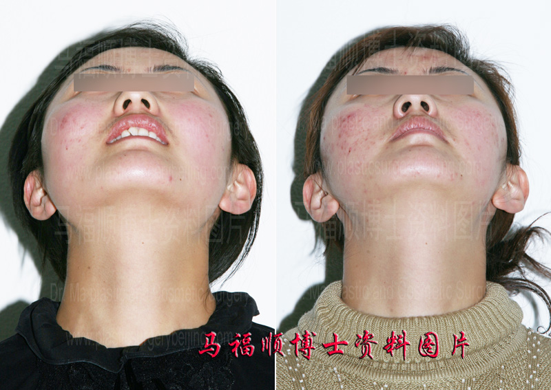 chin up position of zygomatic reduction surgery