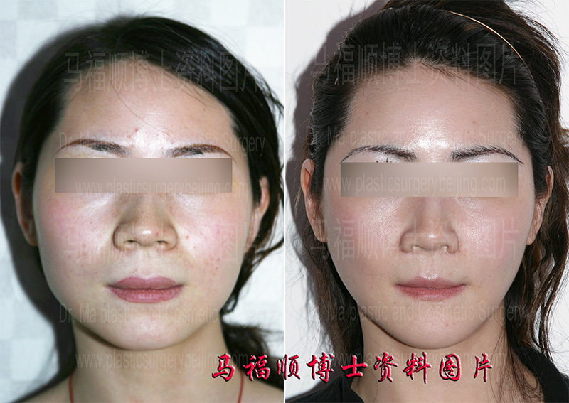face reduction