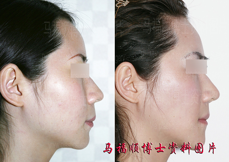 face redution profile view