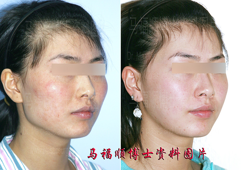 big face reduction surgery big face reduction surgery
