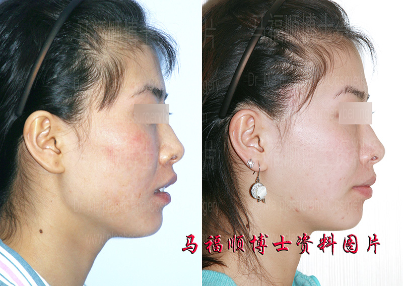 big face rudtion surgery before and after big face rudtion surgery before and after