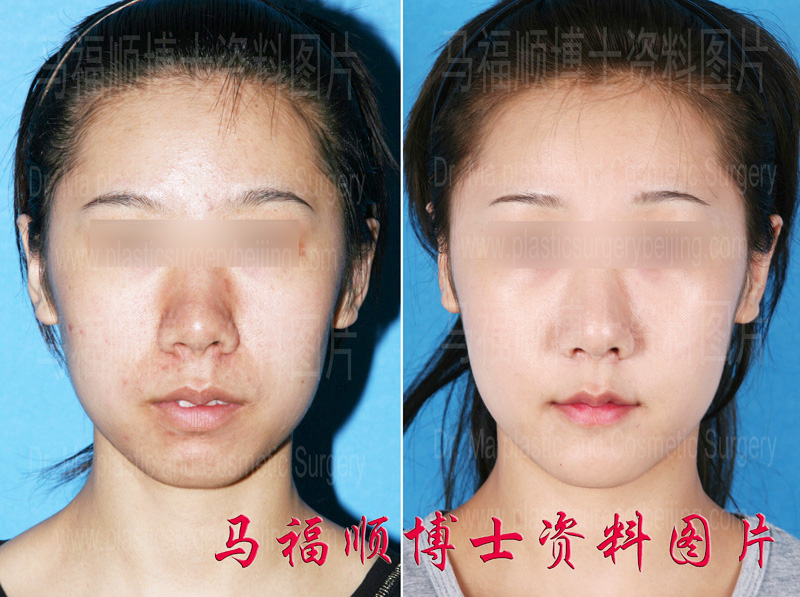 Minor Mouth Protrusion Correction Surgery