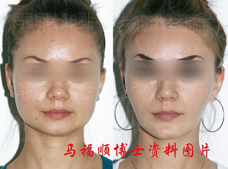 Mandible Angle Reduction Surgery With an Exaggerated Face Reshaping Result