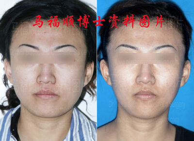 Asymmetric Lower Face Correction and Reduction Surgery