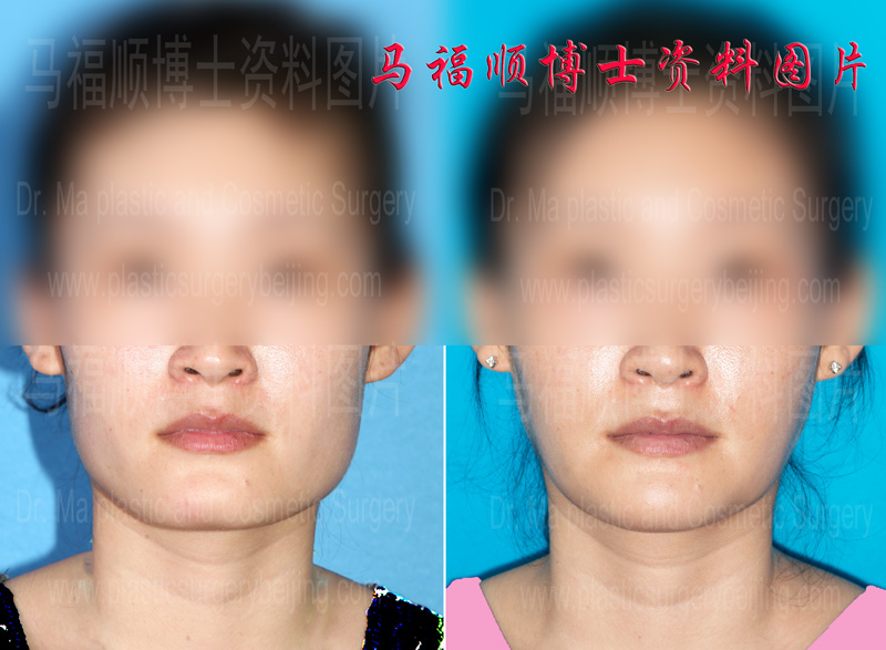 Whole Mandible bone Reduction Facial Reshaping