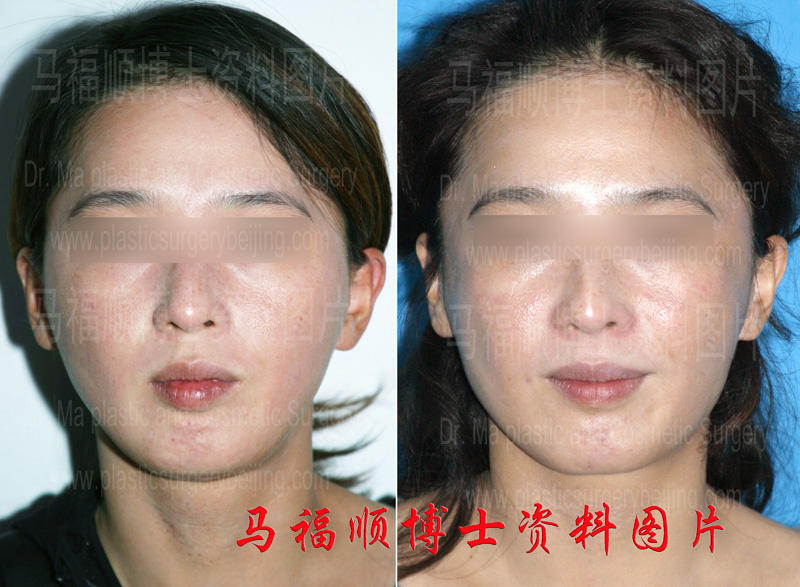 Revision Surgery for Overdone Mandible Angle Reduction