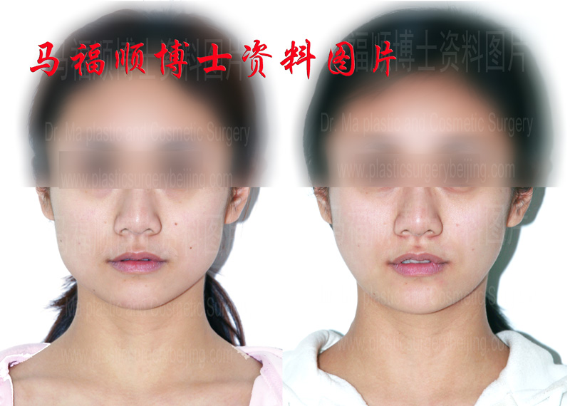 Masseter Muscle Partial Resection Square Face Reduction