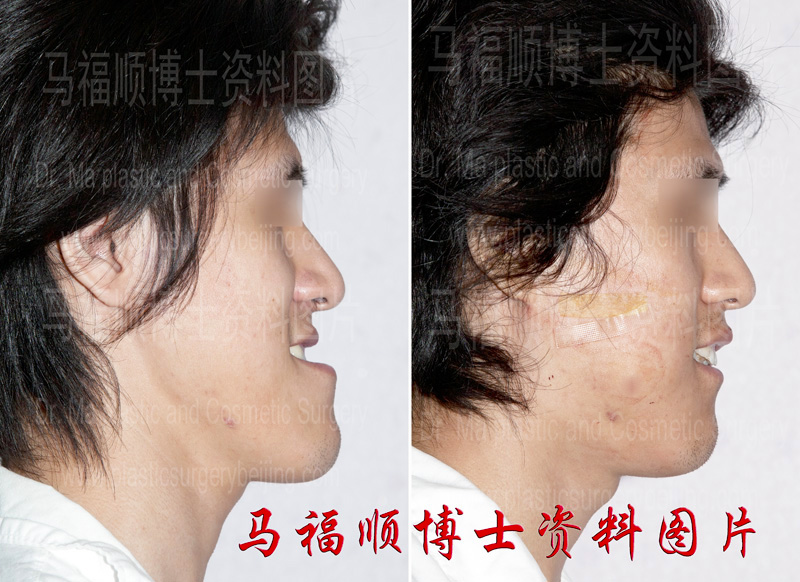 Protrusion Mandible Reduction Surgery