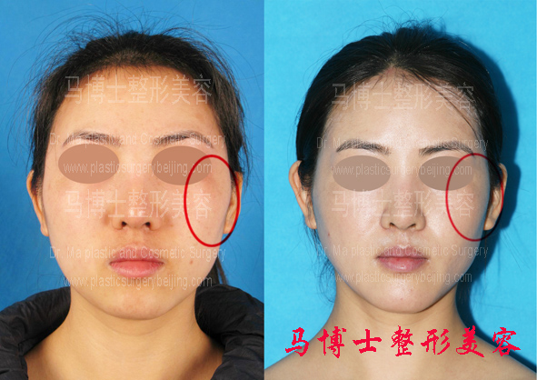 Zygoma and Zygomatic Arch Reduction Plus Chin Forwarding Surgery